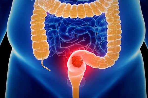 أسباب سرطان القولون والمستقيم