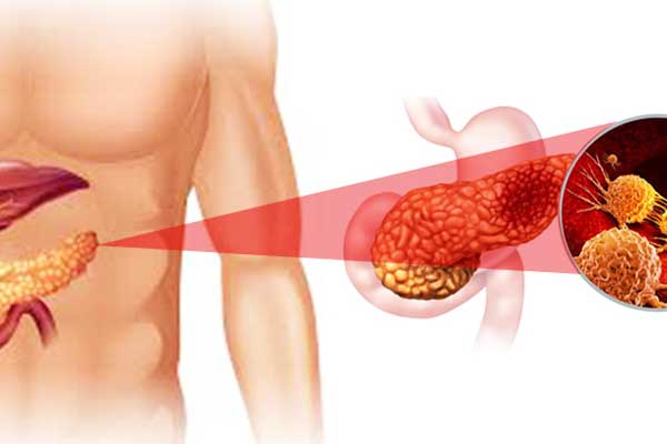 أعراض سرطان البنكرياس