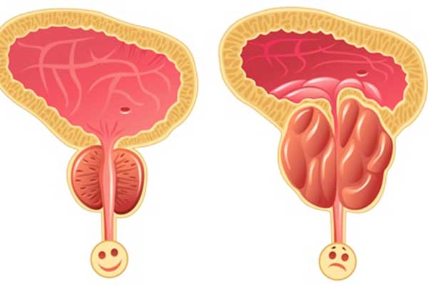 اعراض البروستات