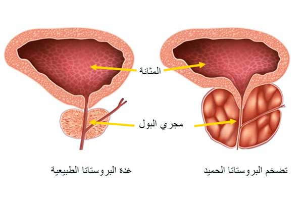 البروستات الحميد