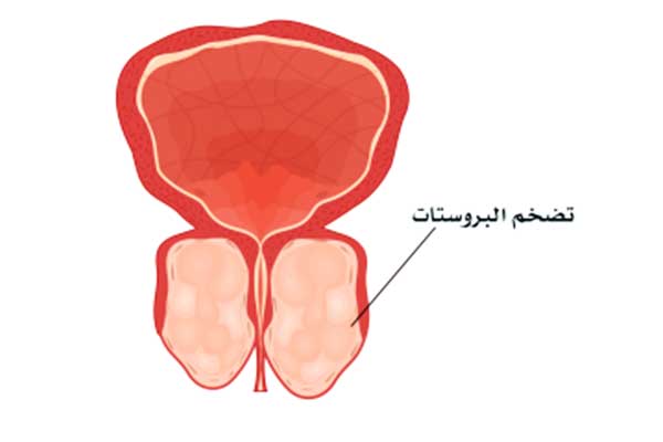 البروستات والخصية