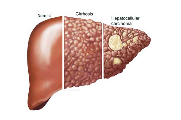 مراحل سرطان الكبد