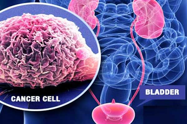 مراحل سرطان المثانة